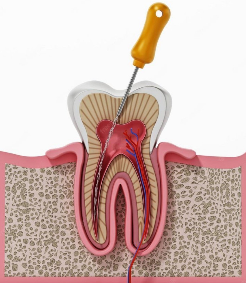 Tooth Extraction